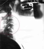 X-ray of Simon's neck showing fracture/dislocation Photo